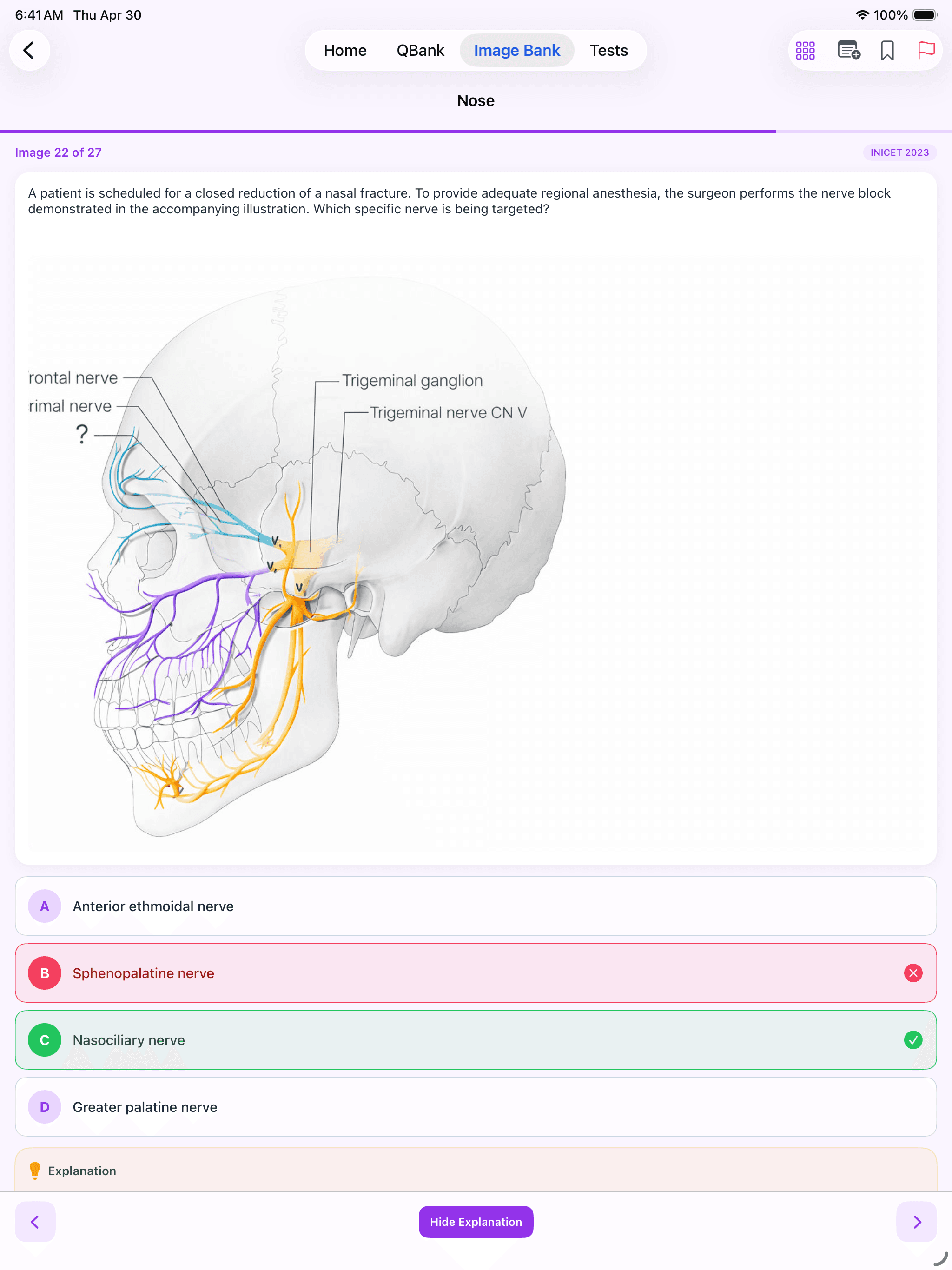 Kinase Image Bank — ECG strip with worked explanation